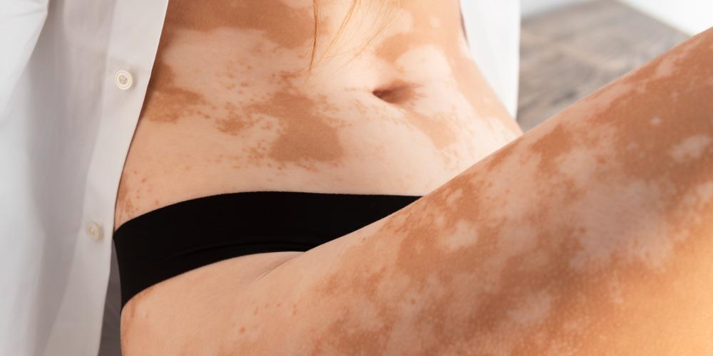 O vitiligo é uma doença não contagiosa que causa a despigmentação da pele em diferentes partes do corpo de uma pessoa (Freepik)