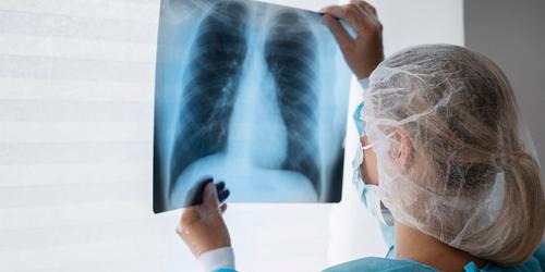 Tuberculose: Coordenadora do Ministério da Saúde tira dúvidas sobre doença
 (Freepik)